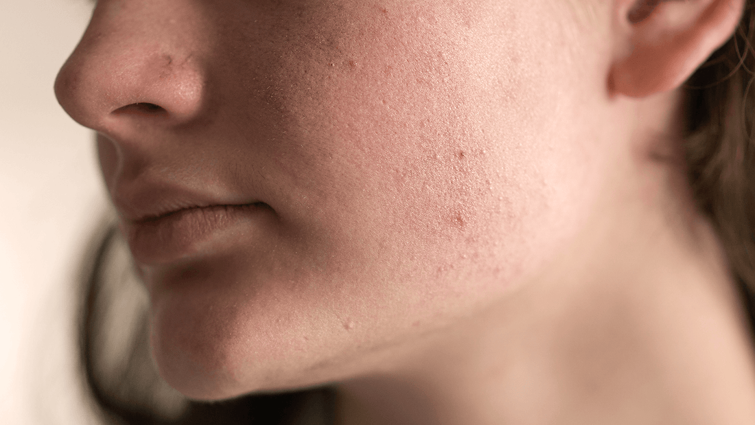 Schrale huid? Exfoliëren of juist met rust laten?